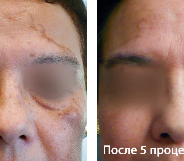 Lumenis PiQo4 Фото До и После 1
