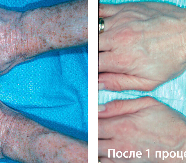 Lumenis PiQo4 Фото До и После 2