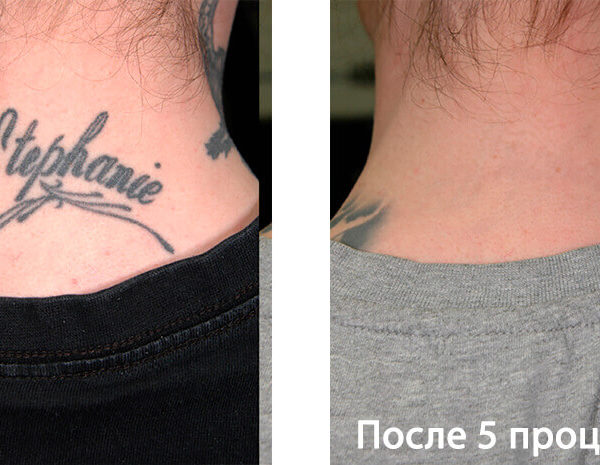 Lumenis PiQo4 Фото До и После 7