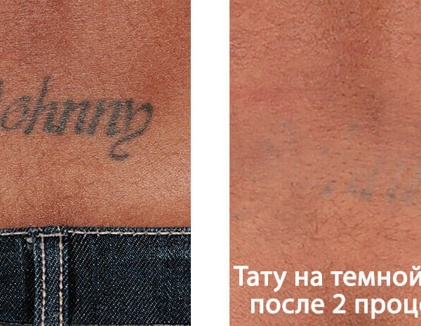 Lumenis PiQo4 Фото До и После 8