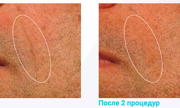 Lumenis Legend Pro Результат До и После 1