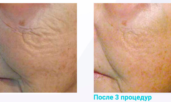 Lumenis Legend Pro Результат До и После 2