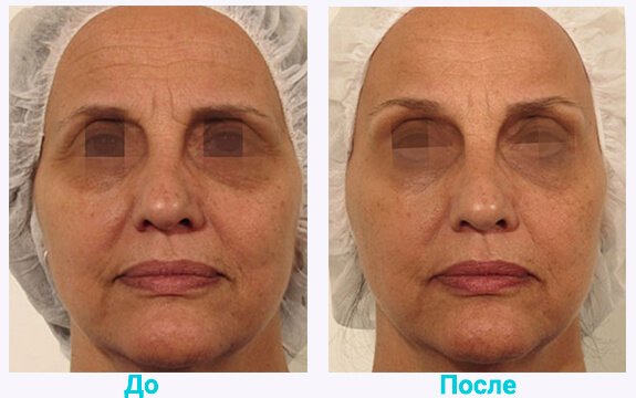 Lumenis Geneo Результат До и После 9